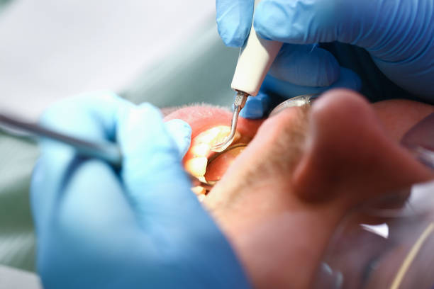 Best Emergency Root Canal Treatment in River Bend, NC
